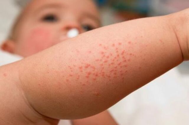 skin rash caused by parasites