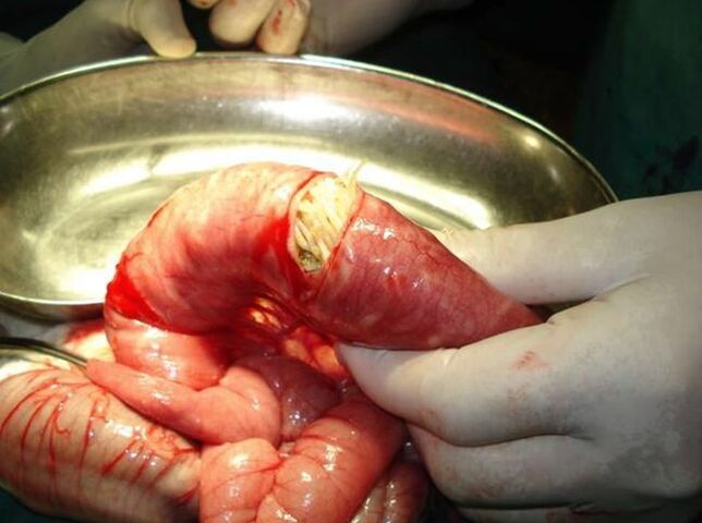 worms in the human gut
