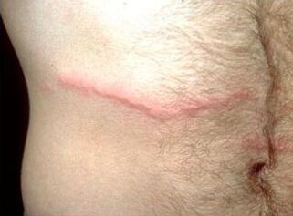How to get rid of people's subcutaneous parasites