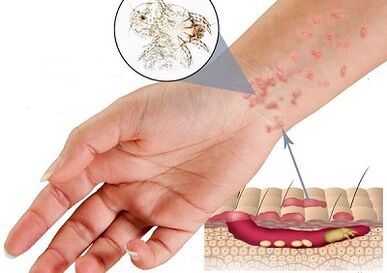 Manifestation of the presence of subcutaneous parasites in people