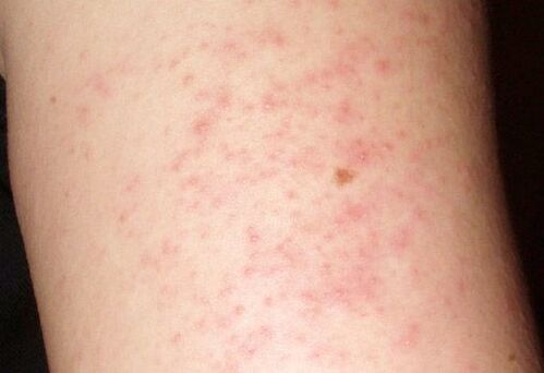 Itchy rashes are a symptom of the presence of worms in the liver