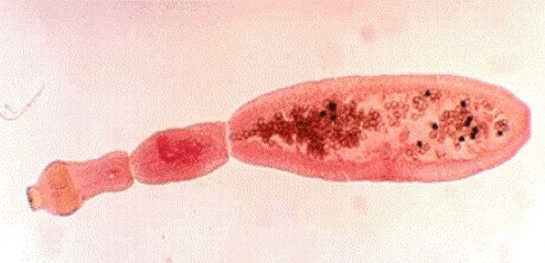 what does echinococcus look like in the human body