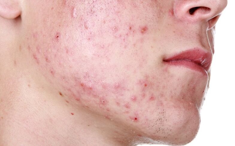 rash caused by parasites on the face